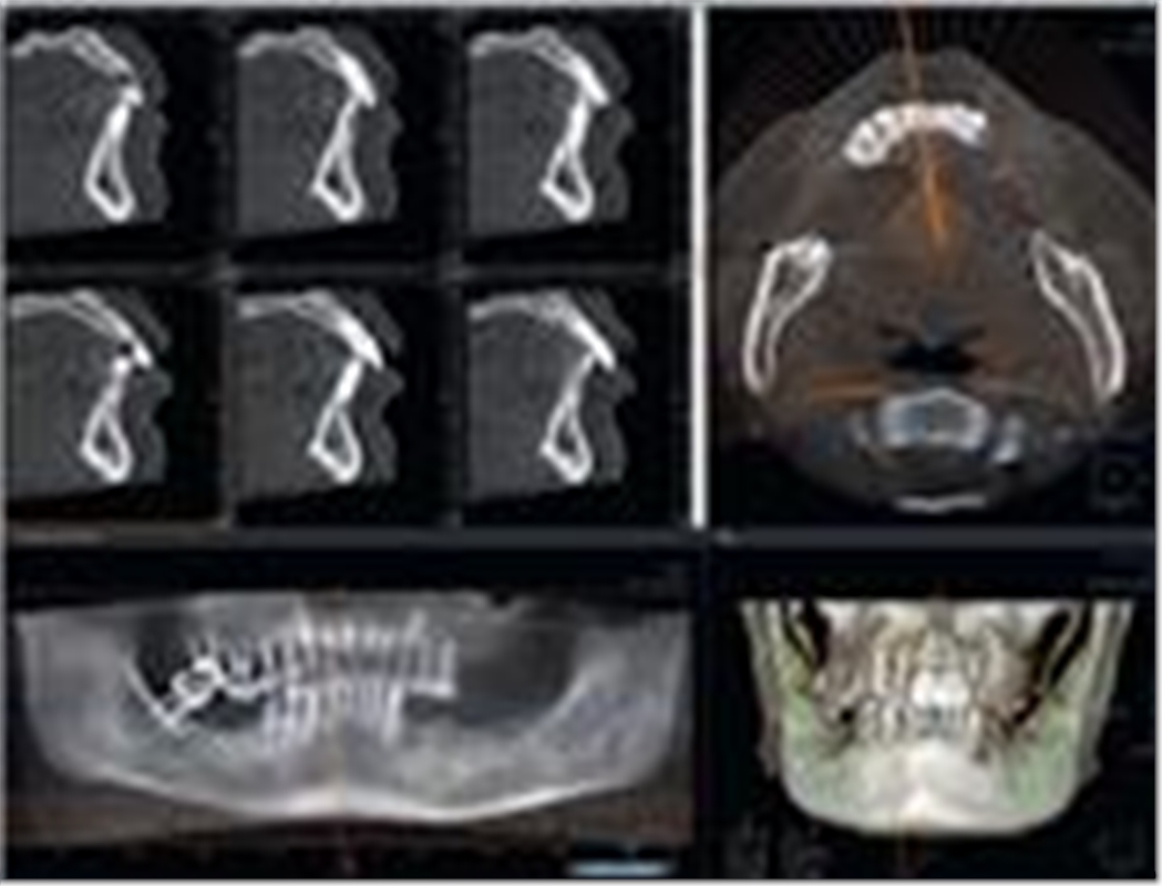 3D OPG OG TOMOGRAPHY